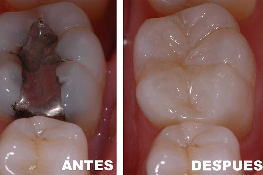 amalgama v/ fotocurado